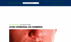 Acnehormonalenhombres.com thumbnail