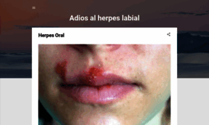 Adiosalherpeslabial.blogspot.com.ar thumbnail