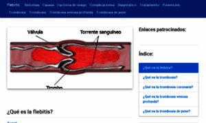 Flebitis.net thumbnail